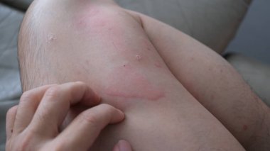 Şiddetli ürtiker, kurdeşen ya da kaligata çeken deri dokusunu yakından çek. Alerji belirtileri..