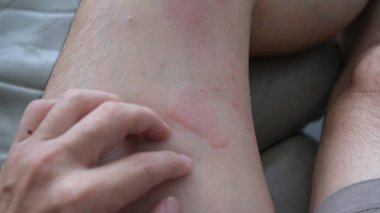 Şiddetli ürtiker, kurdeşen ya da kaligata çeken deri dokusunu yakından çek. Alerji belirtileri..