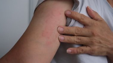 Eller alerjik bir kolu kaşındırıyor şiddetli ürtiker, kovan ya da kaligata yüzünden acı çekiyor..