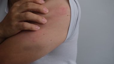 Eller alerjik bir kolu kaşındırıyor şiddetli ürtiker, kovan ya da kaligata yüzünden acı çekiyor..