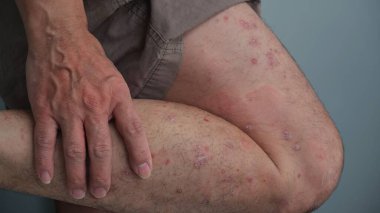 Bacaklarında kronik küçük plaklar olan bir adam..