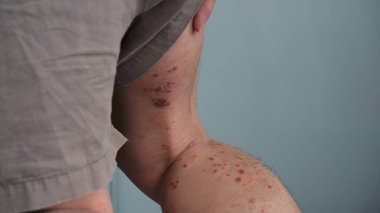 Bacaklarında kronik küçük plaklar olan bir adam..