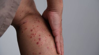 Cilt kızarıklığının ilk belirtileri. Sonra kurur ve sedef hastalığına dönüşür..