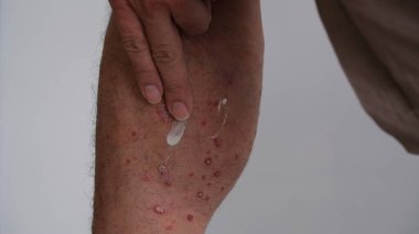 Adamın biri bacağına sedef hastalığı kremi sürüyor..