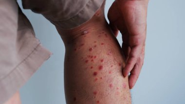 Cilt kızarıklığının ilk belirtileri. Sonra kurur ve sedef hastalığına dönüşür..