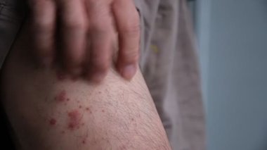 Bacaklarında kronik küçük plaket sedef hastalığı olan bir adam..