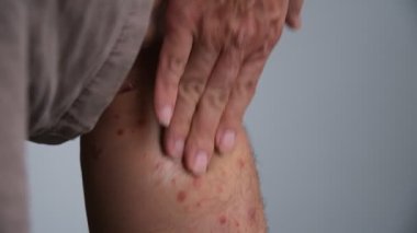 Adamın biri bacağındaki kronik küçük sedef hastalığına sedef kremi sürüyor..