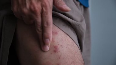 Adamın biri bacağındaki kronik küçük sedef hastalığına sedef kremi sürüyor..