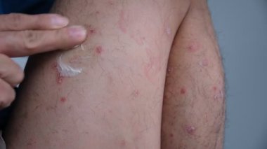 Adamın biri bacağındaki kronik küçük sedef hastalığına sedef kremi sürüyor..