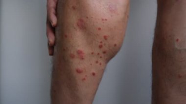Bacaklarında kronik küçük plaket sedef hastalığı olan bir adam..