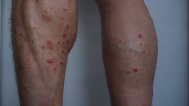 Bacaklarında kronik küçük plaket sedef hastalığı olan bir adam..