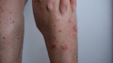 Bacaklarında kronik küçük plaket sedef hastalığı olan bir adam..