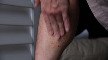 Adamın biri bacağındaki kronik küçük sedef hastalığına sedef kremi sürüyor..