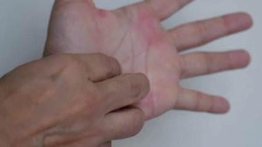 El, deri kovanına alerjisi ya da ürtiker yüzünden kırmızı olan avuç içini tırmalıyor..