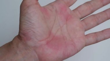El, deri kovanına alerjisi ya da ürtiker yüzünden kırmızı olan avuç içini tırmalıyor..