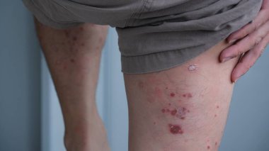 Cilt kızarıklığının ilk belirtileri. Sonra kurur ve sedef hastalığına dönüşür..