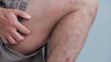 Cilt kızarıklığının ilk belirtileri. Sonra kurur ve sedef hastalığına dönüşür..