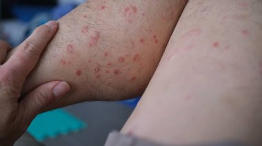 Cilt kızarıklığının ilk belirtileri. Sonra kurur ve sedef hastalığına dönüşür..