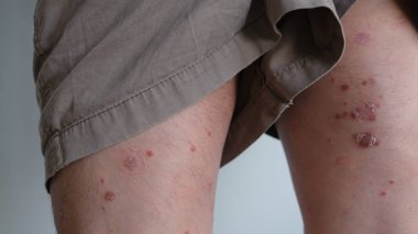 Cilt kızarıklığının ilk belirtileri. Sonra kurur ve sedef hastalığına dönüşür..