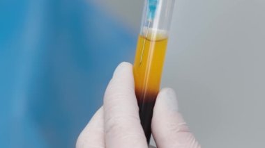 Doctor cosmetologist draws blood plasma into a syringe for the plasmolifting procedure, hands in gloves closeup. PRP therapy treatment in beauty clinic. Cure of problem skin.