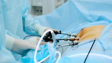 Ameliyat odası, laparoskopik müdahale yapan cerrahlar. Modern tıp, hastanede tıbbi malzemeler. Laparoskop aletleri. Doktorlar endo-enstrümanlar ve video kameralar kullanır