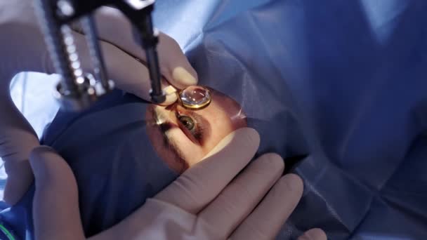 Synkorrigering Med Mikroskop Kirurgens Händer Handskar Som Utför Synkorrigering Med — Stockvideo