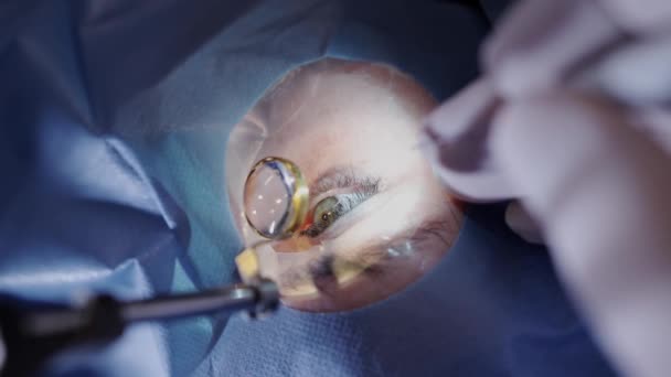Zichtcorrectie Met Microscoop Chirurgische Handen Handschoenen Die Laseroog Correctie Uitvoeren — Stockvideo