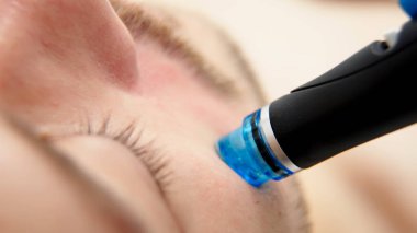 Man undergoes a hydrofacial treatment at a beauty clinic. This advanced procedure rejuvenates and revitalizes the skin, ideal for showcasing premium skincare services in your advertising. clipart