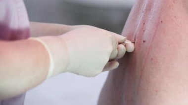 Eldivenli el, deriye akupunktur iğnesi sokuyor.