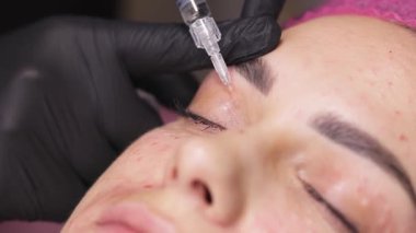 Prosedür sırasında kaş yakınına kozmetik doldurucu enjekte ediliyor