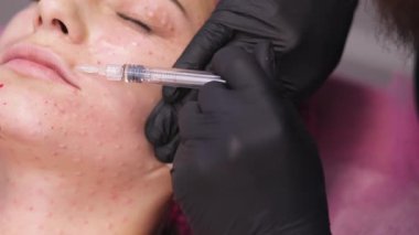 Kadının yanak derisine kozmetik doldurucu enjekte ediliyor.