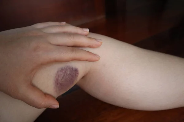 Bruise Leg Young Woman — Stock Photo, Image