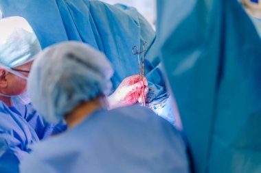 Valmiera, Letonya - 20 Mart 2024 - Cerrahlar, parlak bir ameliyathanede kanlı eller, cerrahi aletler, mavi elbiseler ve perdelerle ameliyat yapıyorlar..