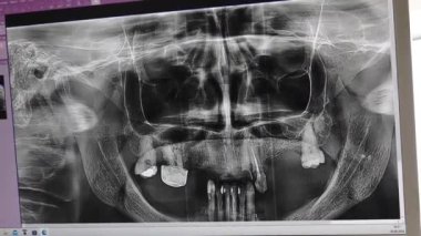 Valmiera, Letonya - 27 Haziran 2024 - Detaylı diş ve çene yapısını gösteren bir bilgisayar ekranında diş panoramik röntgeni.