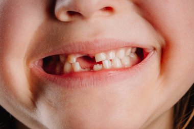 Ön dişleri eksik, gülümseyen bir çocuğun yakın çekimi. Görüntü diş kaybını, büyümeyi ve çocukluk gelişimini vurguluyor