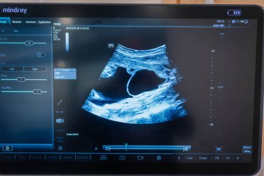 Valmiera, Letonya - 31 Mayıs 2025 - Mindray ultrason monitörü, klinik görüntüleme ortamında görünür ayarlar ve gri tonlama arayüzü ile eş zamanlı abdominal tarama gösteriyor.