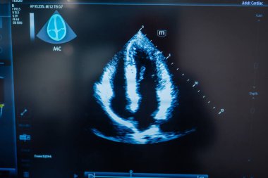 Valmiera, Letonya - 31 Mayıs 2025 - Gri ölçekli görüntüleme teknolojisi kullanılarak kalp odalarına ait ultrason görüntüsü (A4C).