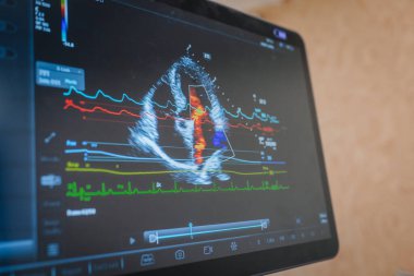 Valmiera, Letonya - 31 Mayıs 2025 - Mindray ultrason monitöründe ECG ve kan akışı verileri ile eş zamanlı kalp fonksiyonlarını gösteren renkli Doppler ekogramı.