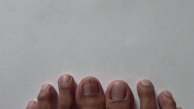 Görünür kuru derili erkek ayakları ve düz beyaz arka planda dinlenen aşırı gelişmiş ayak tırnakları.