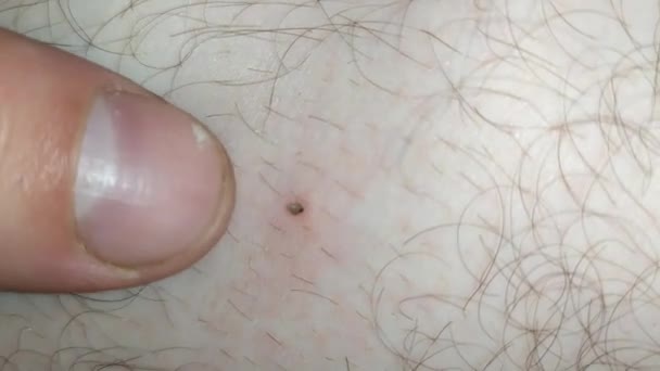 Small Tick Has Clung Skin Sucks Out Human Blood High — Stock Video