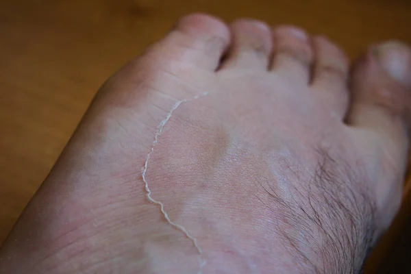 足首の近くの足では ポルトガルのビーチで夏の最初の日に強い日焼けから皮膚の薄い層が剥がれ落ち足から剥がれ落ちる — ストック写真