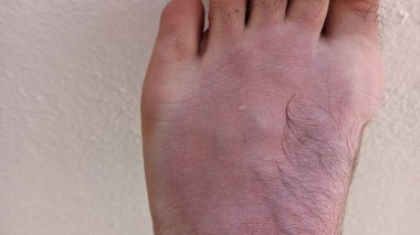 Ayakta bronz ten, Portekiz 'de yaz fotoğrafında güneş yanığı.