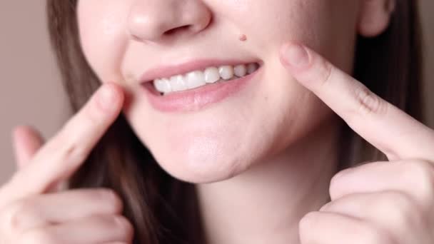 Een Jong Meisje Gebruikt Uitlijnaars Haar Tanden Recht Trekken Hoge — Stockvideo