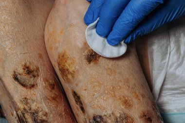 Skin lesions on the leg. Symptoms characteristic of the elderly begin with a red rash in a small circle and spread to a wider area. Large scabs on the legs. Elderly care. Consequences of diabetes