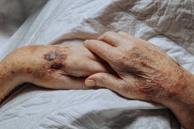 A bruise on the hand of an elderly person. Known as senile purpura. Caused by the fragility of the skin and blood vessels in old age. Elderly care