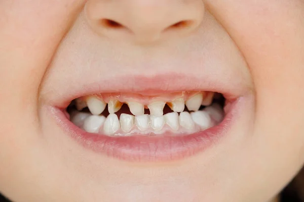 Kindermelktanden Met Cariës Close Van Ongezonde Melktanden Tandheelkundige Geneeskunde Gezondheidszorg — Stockfoto