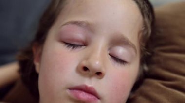 Göz kapağında şişmeye, kızarıklığa, ısıya ve kaşıntıya neden olan böcek, sivrisinek ya da arı ısırıklarının yol açtığı küçük bir çocukluk enfeksiyonu. Küçük bir kızda sivrisinek ısırığı üstüne alerji.