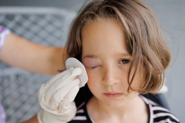 Göz kapağında şişmeye, kızarıklığa, ısıya ve kaşıntıya neden olan böcek, sivrisinek ya da arı ısırıklarının yol açtığı küçük bir çocukluk enfeksiyonu. Küçük bir kızda sivrisinek ısırığı üstüne alerji.