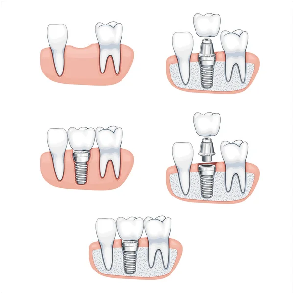 Implante Dental Diente Corona Ilustración Dientes Saludables Dentista Vector Ilustración — Vector de stock