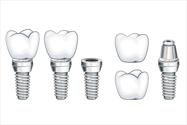 Implante Dental Diente Corona Ilustración Dientes Saludables Dentista Vector Ilustración — Vector de stock